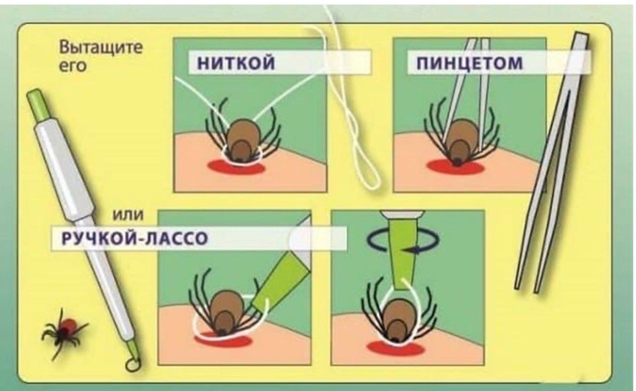 Клеща выкручивать против или по часовой стрелке. Как удалить клеща с тела человека. Как достать клеща у человека пинцетом. Как правильно вынуть клеща. Как вытащить клеща у человека самостоятельно.